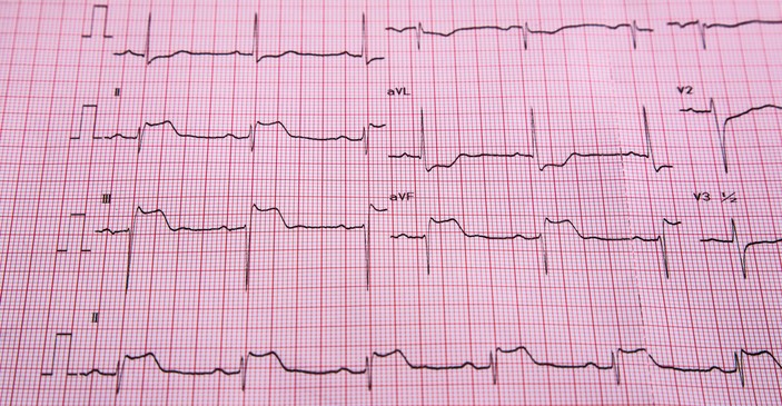 EKG - STEMI - ST-nousun ja sydänlihasinfarktin merkit.