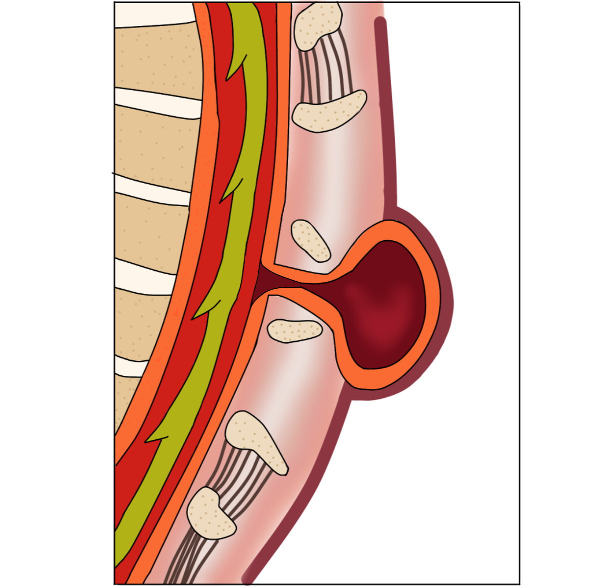 Meningocele