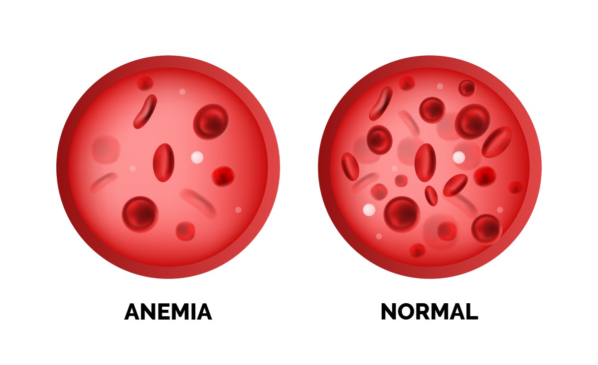 Anemia ja normaali veren punasolujen määrä