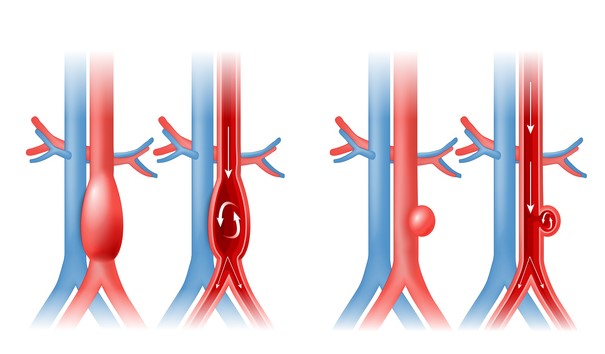 Aortan aneurysma ja verenkierto