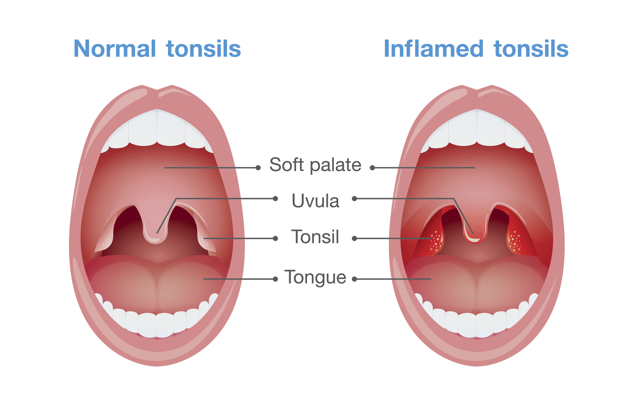 Angina - nielurisojen tulehdus