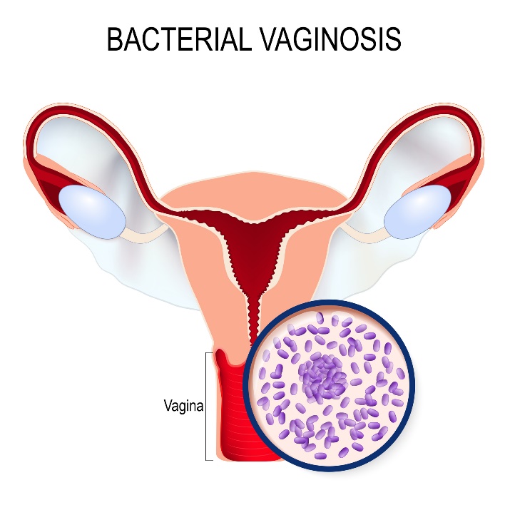 Bakteerivaginoosi ja Gardnerella vaginalis -bakteerin liikakasvu