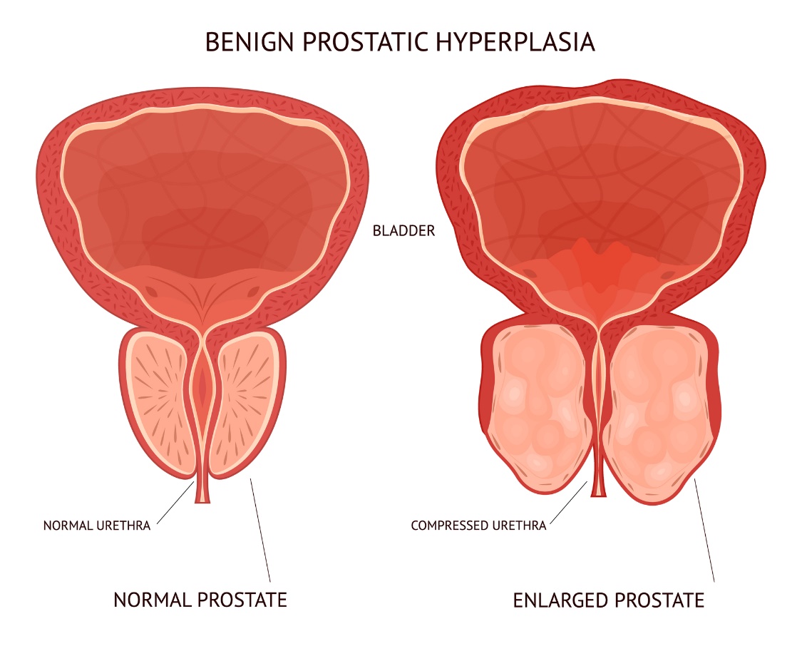 hyvänlaatuinen eturauhasen liikakasvu (hyperplasia)