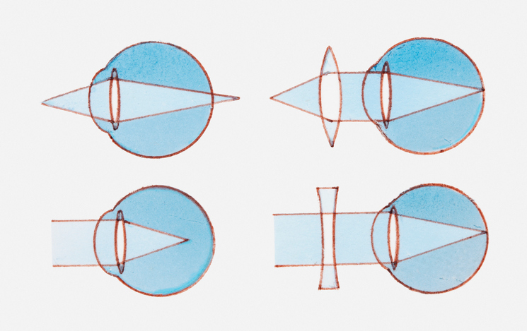 Hyperopia ja myopia 