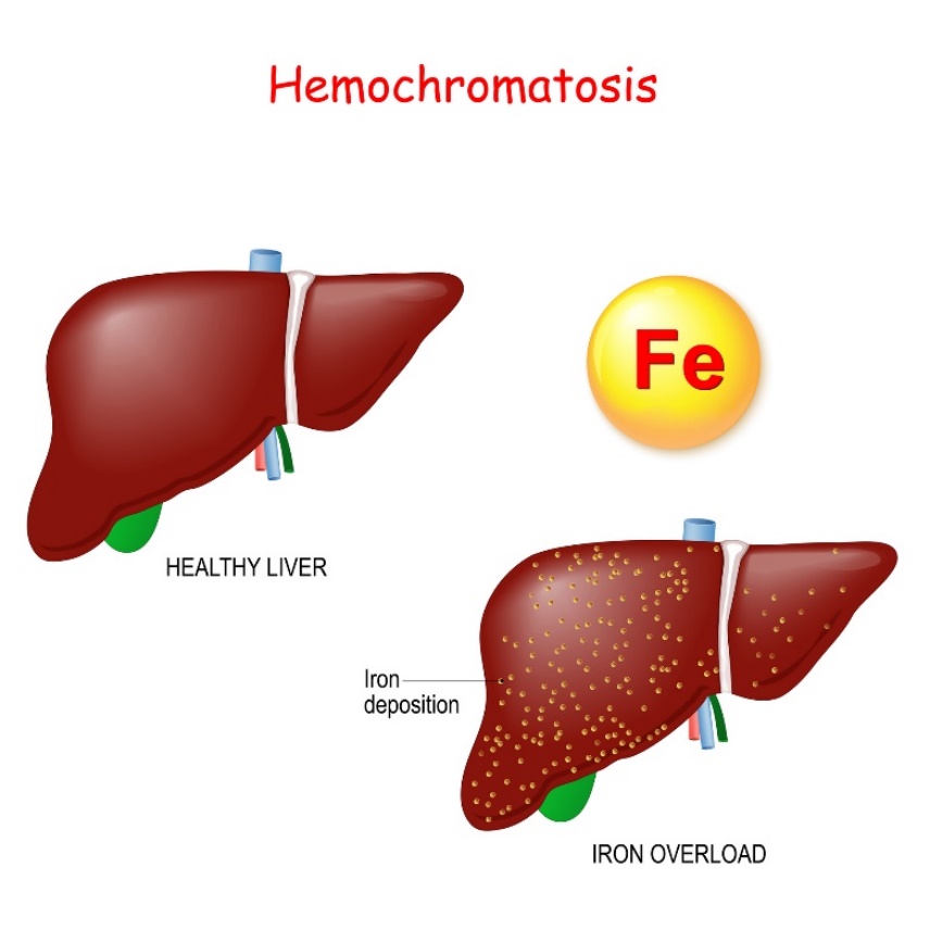 Hemokromatoosi: maksan fysiologia ja patologia, jossa on liiallista raudan (Fe) kerrostumista.