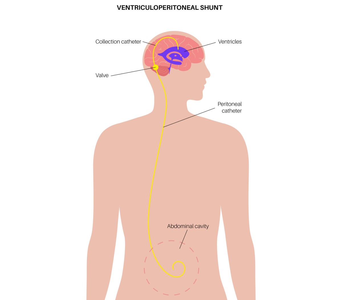 Kuva ventrikulo-abdominaalisesta shuntista, joka johtaa ylimääräisen nesteen aivoista vatsaonteloon.