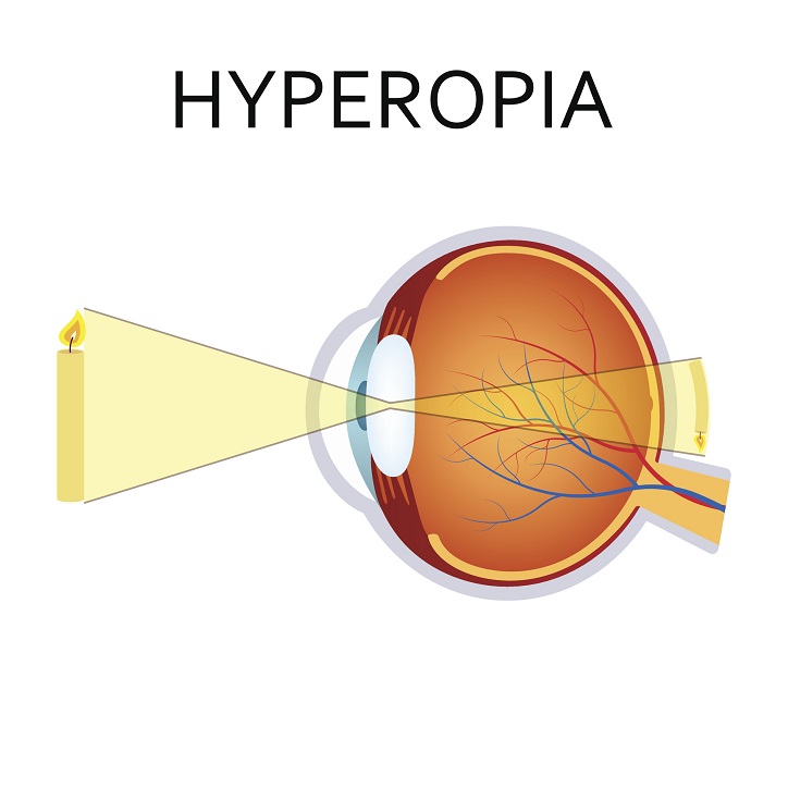 Hyperopia