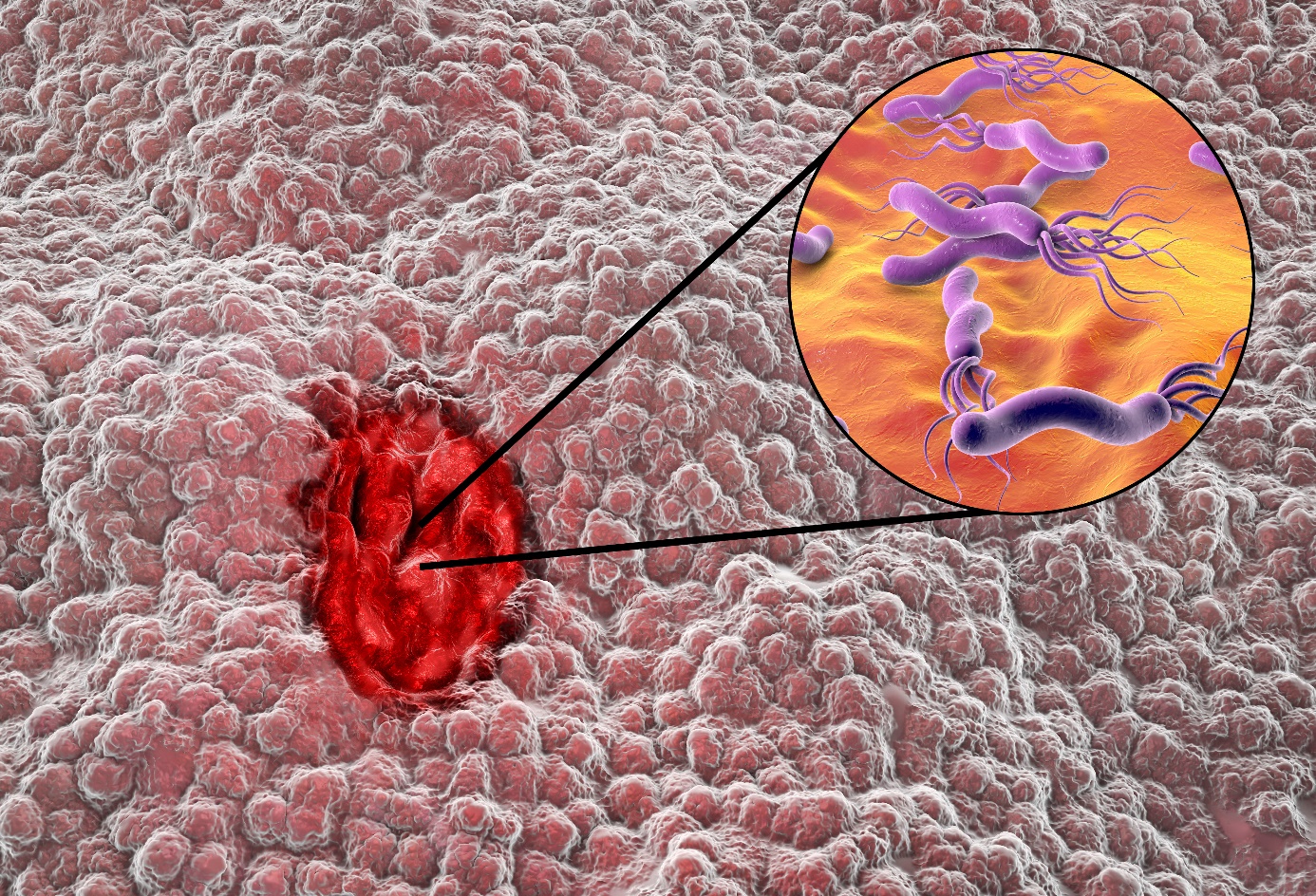 Helicobacter pylori -infektio