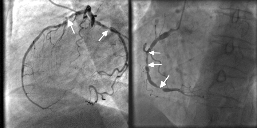 Koronarografia, angiografia, sepelvaltimon tukos