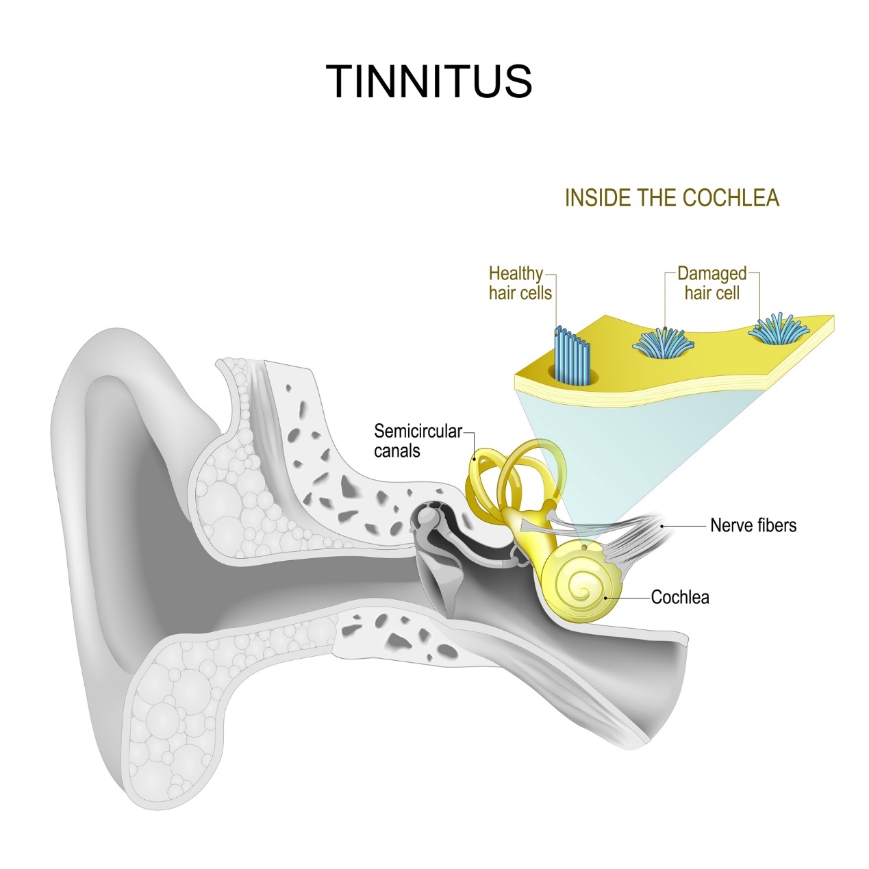 Sisäkorva ja tinnitus - viheltely ja huminaa korvassa.