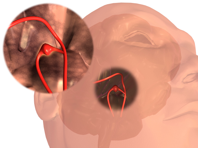 Aivoverisuonen aneurysma