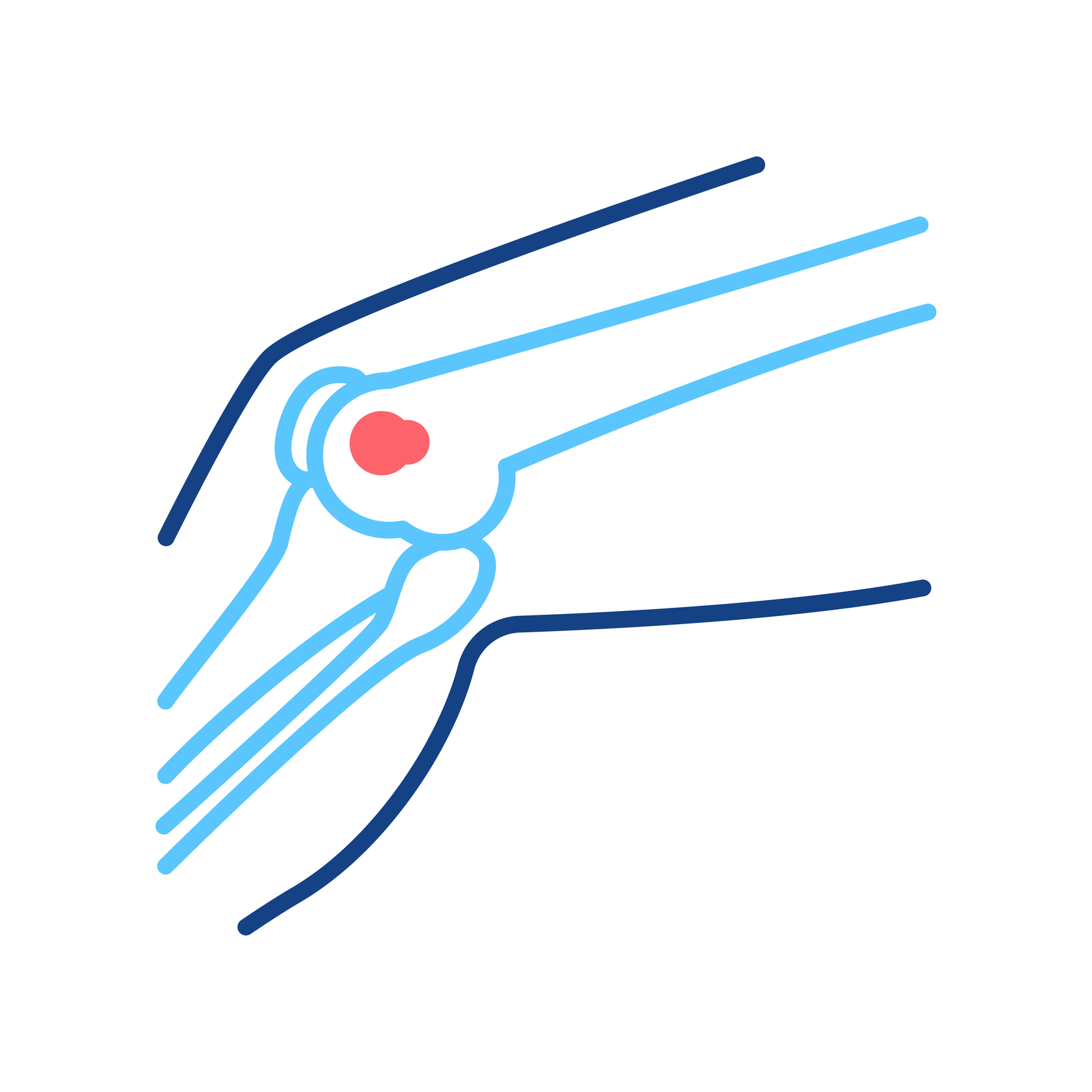 Polven osteosarkooma