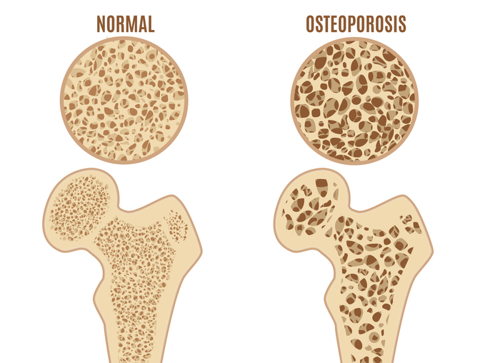 Reisiluun osteoporoosi