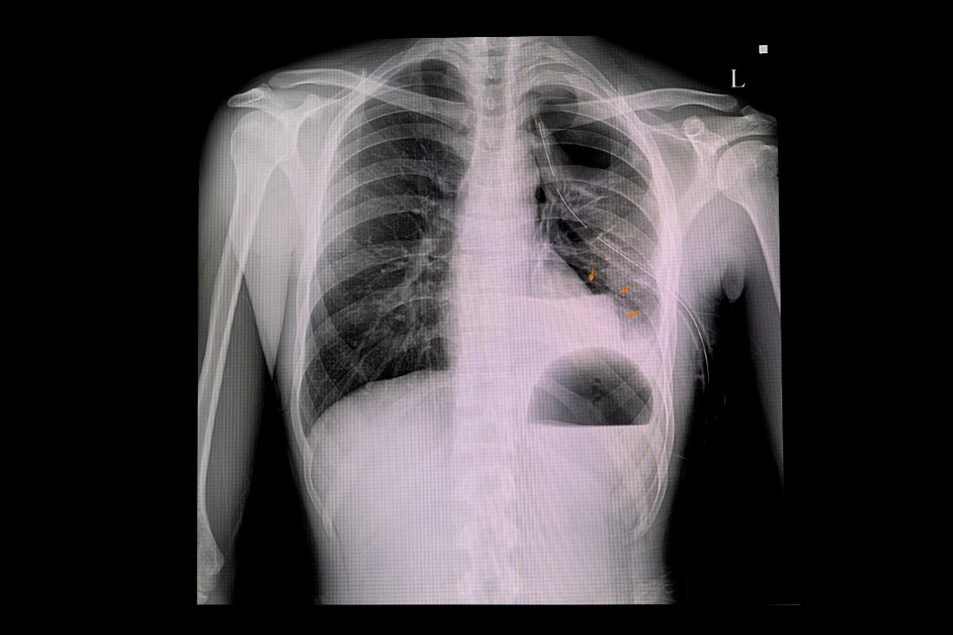 Röntgenkuva vasemman keuhkon pneumothoraxista ja ilmakertymästä rintakehän keuhkopussin onteloon (valkoinen väri).