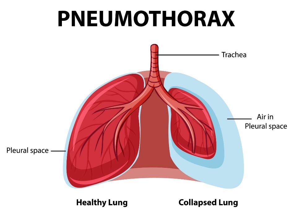 Pneumothorax: terveet ja romahtavat keuhkot.