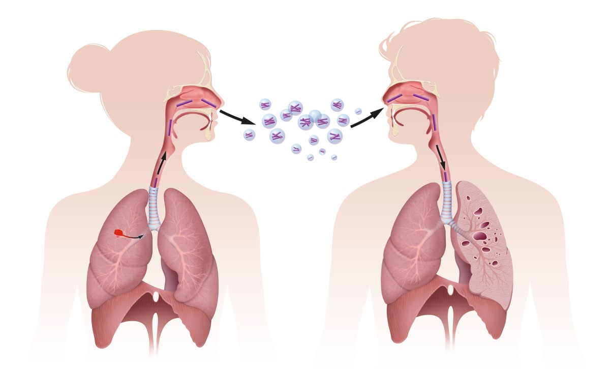 Tuberkuloosin leviäminen hengitysteitse eli inhalaation kautta, kuvassa on esitetty leviäminen hengitysteitse.