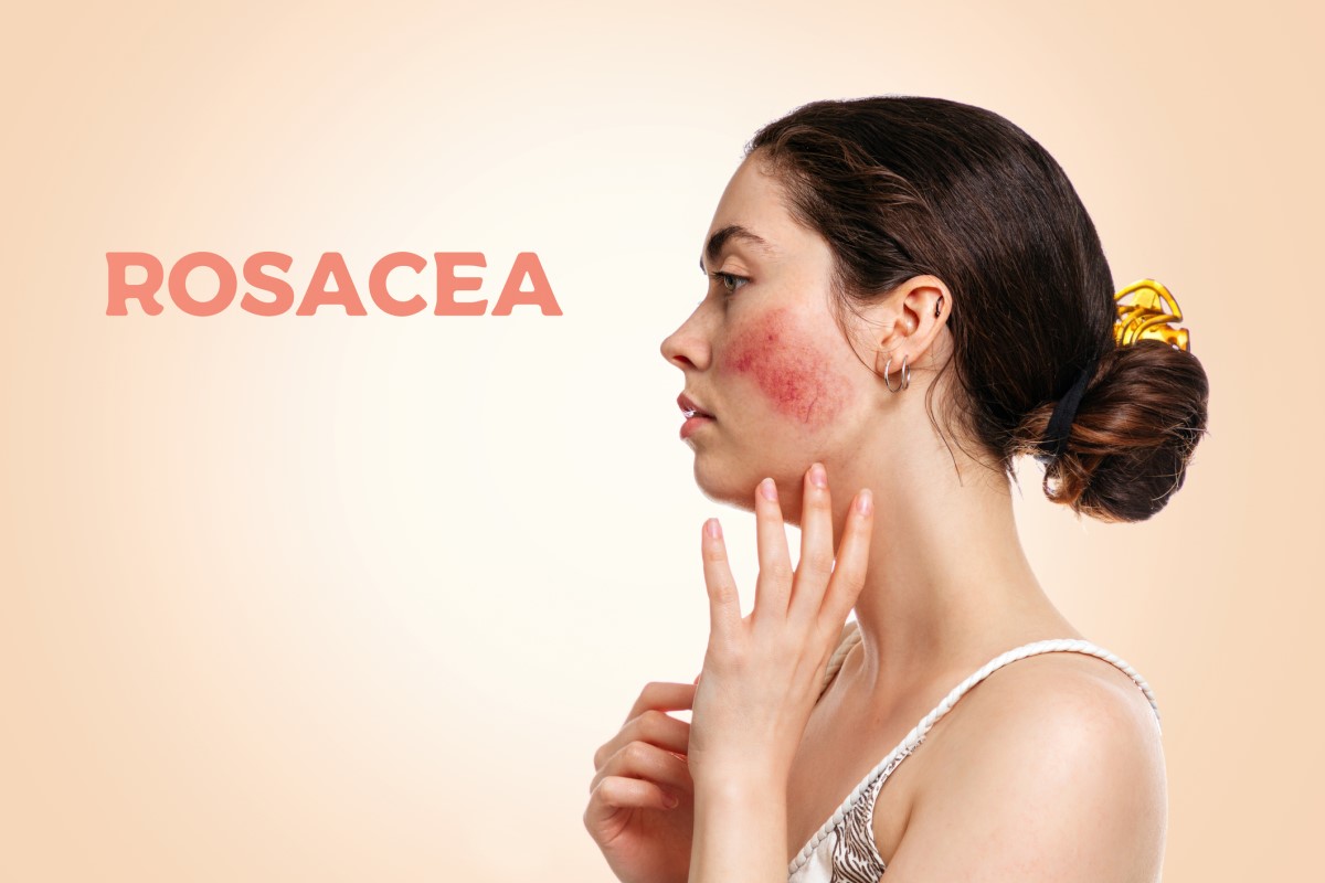 Nainen sivulta, kasvot ruusufinni - ruusufinni - rosacea