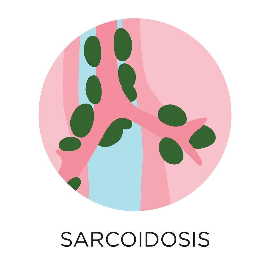 Sarkoidoosi - granuloomien muodostus