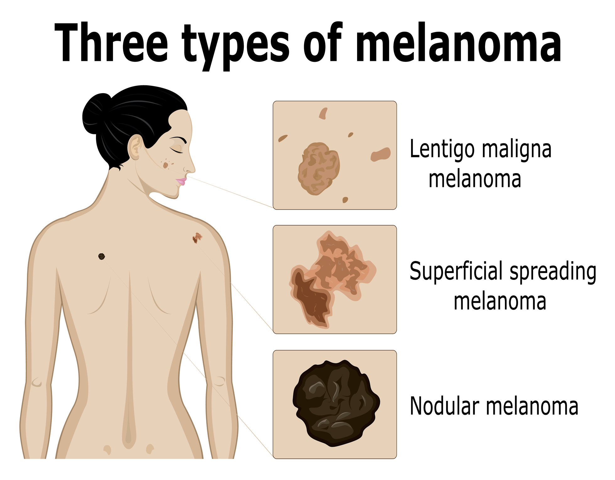 Kolmen melanoomatyypin kuvantaminen