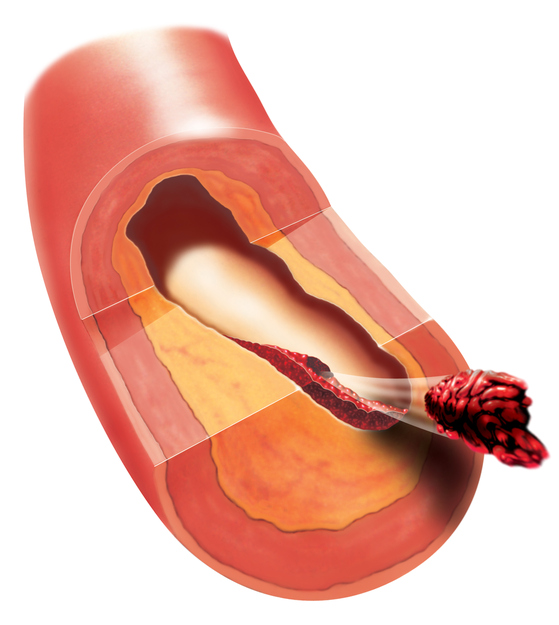 Tromboosi verisuonessa, trombin vapautuminen, embolia, verihyytymän aiheuttama embolia