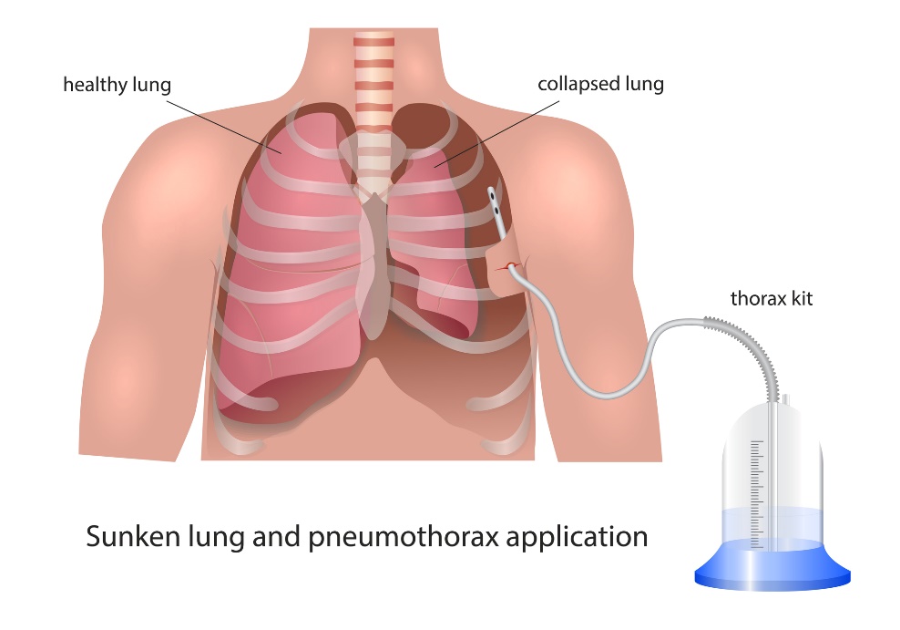 Pleuradreenin visualisointi pneumothoraxissa: terve keuhko, romahtanut keuhko ja dreenauslaite.