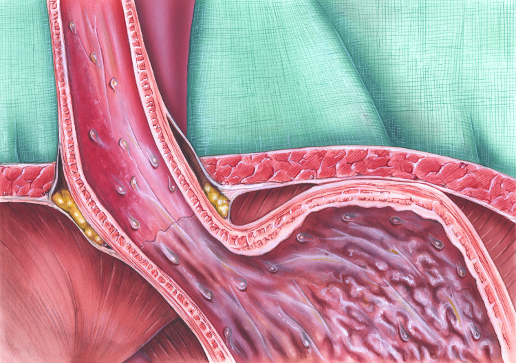 anatomisesti kuvattu ruokatorven sulkijalihaksen sulkijalihas.