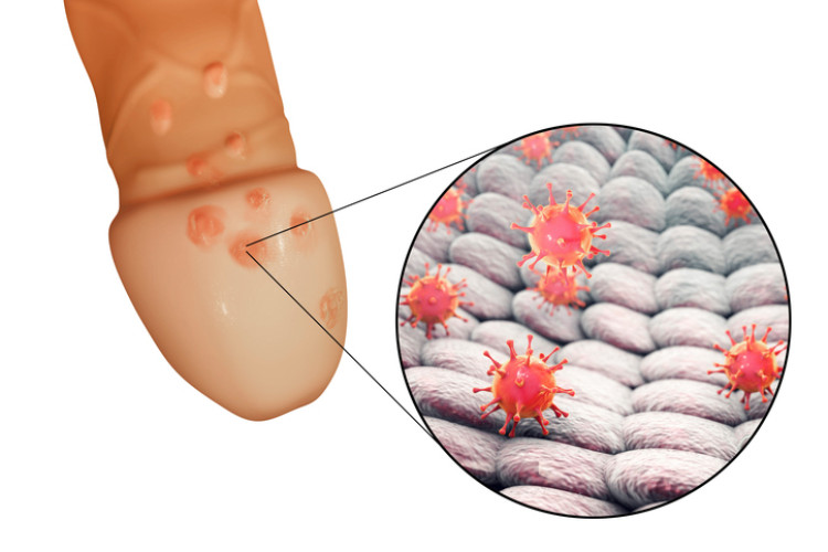 sukupuolielinten herpes peniksessä ja herpesvirus mikroskooppisella tasolla.