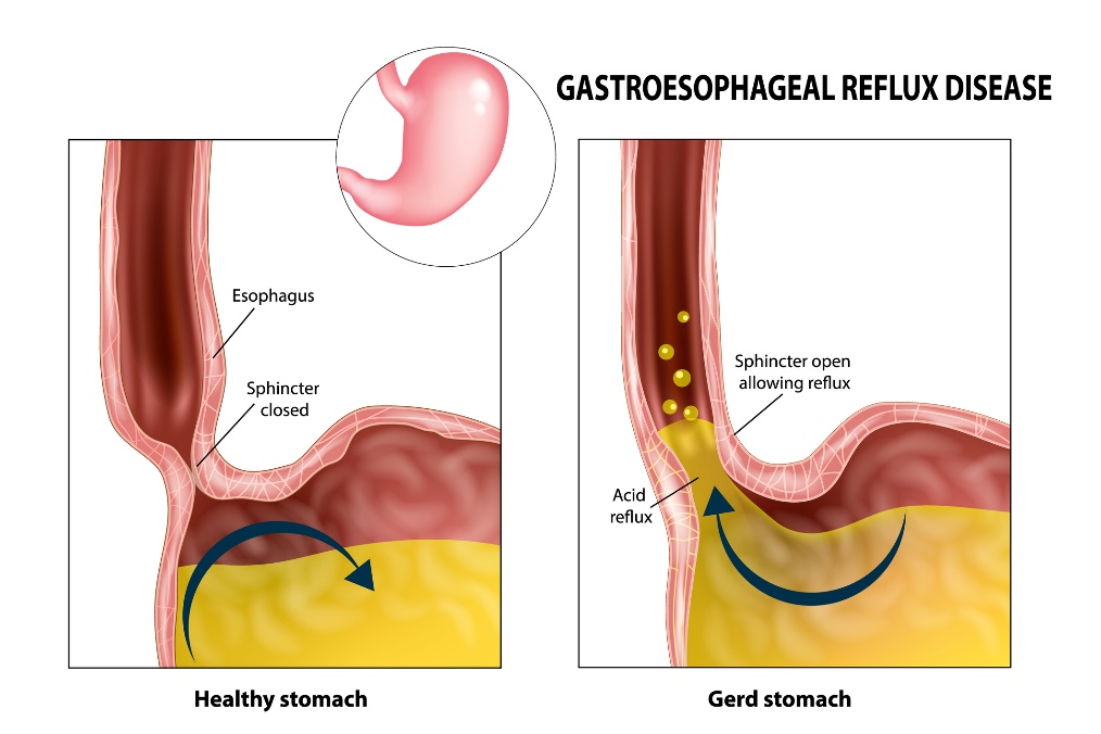 Gastroesofageaalinen refluksi: ruokatorvi, sulkijalihakset, vatsa ja mahahappo.