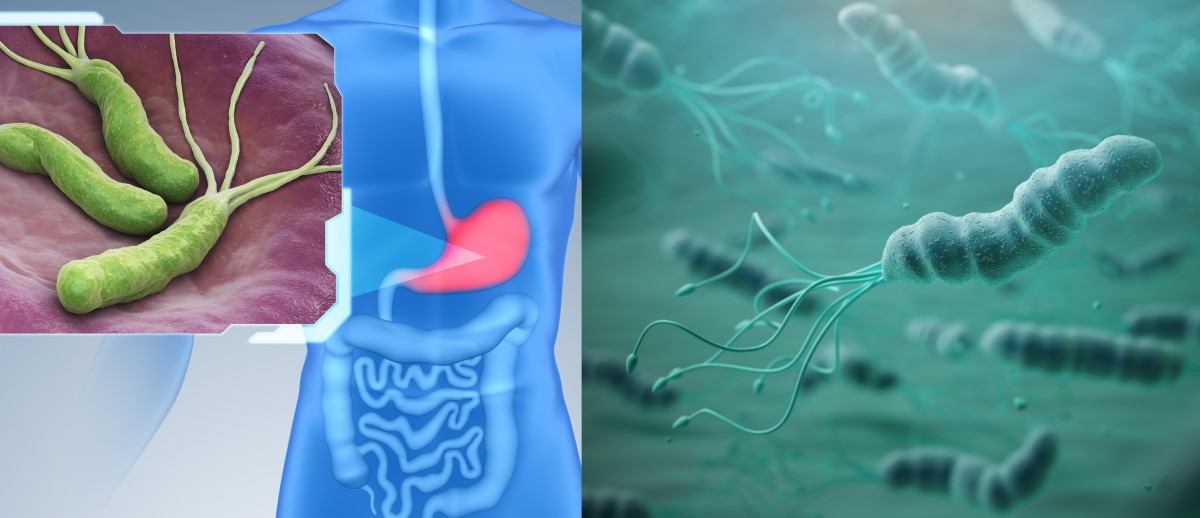 Helicobacter pylori kolonisoi mahalaukun limakalvoa ja on gastriitin, mahahaavan ja syövän riskitekijä.