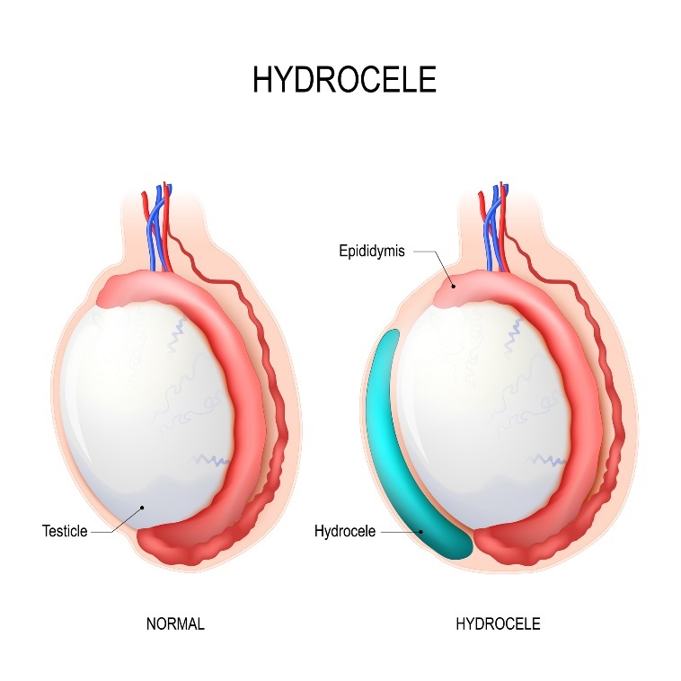 Hydrocele: kives, Epididymis (lisäkivekset), Hydrocele (kertynyt neste).