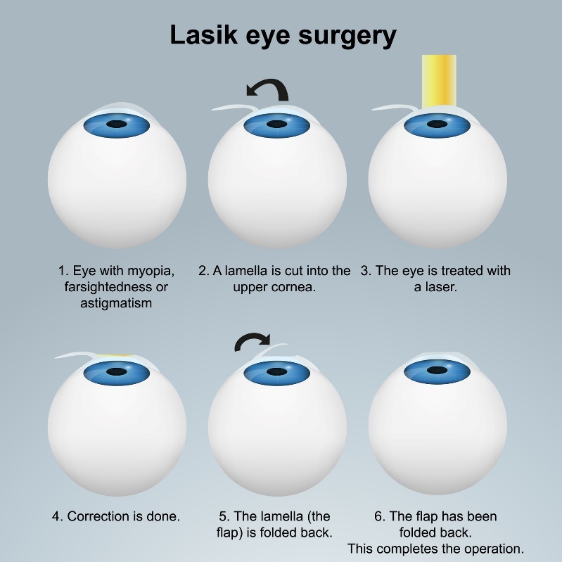 Silmien laserleikkaus LASIK - subsurface-menetelmä. Toimenpide, jossa käytetään läppää/läppiä vahingoittamatta hermopäätteitä.