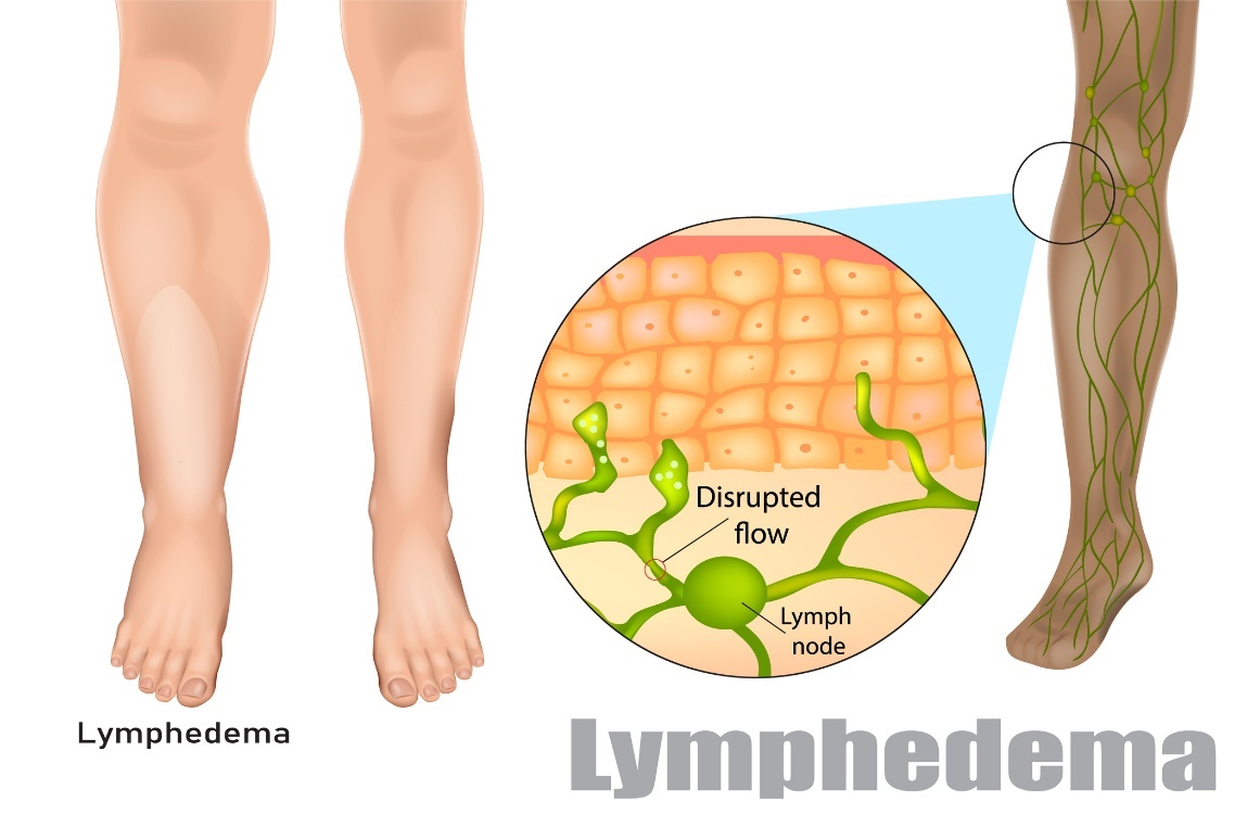 Lymfedeema