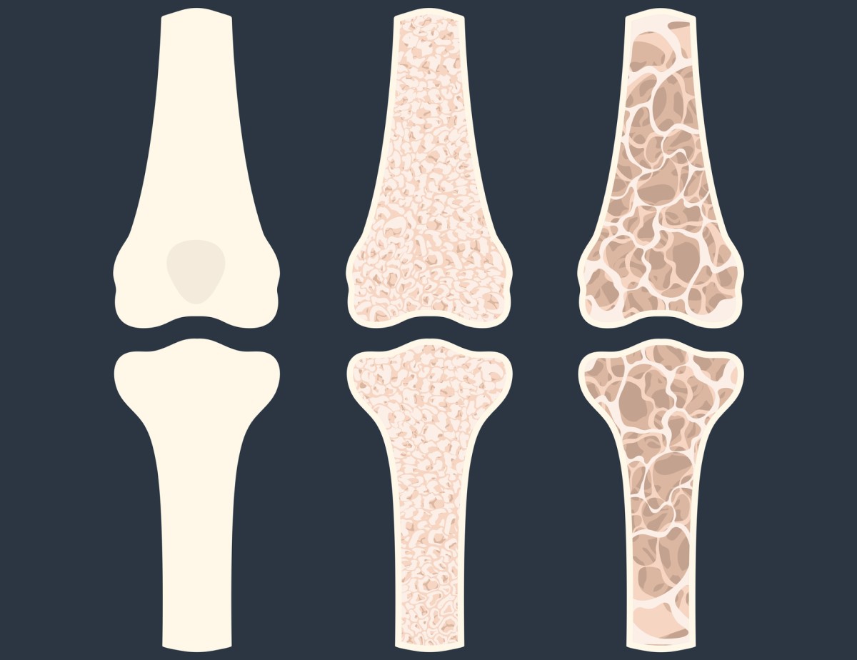 Animaatio kolmesta luusta, jotka osoittavat osteoporoosia - luiden ohenemista.