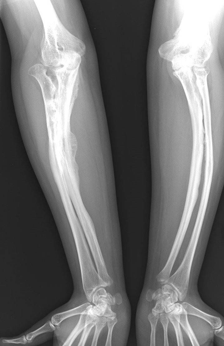 Aikuisen osteogenesis imperfecta -taudin röntgenkuvat