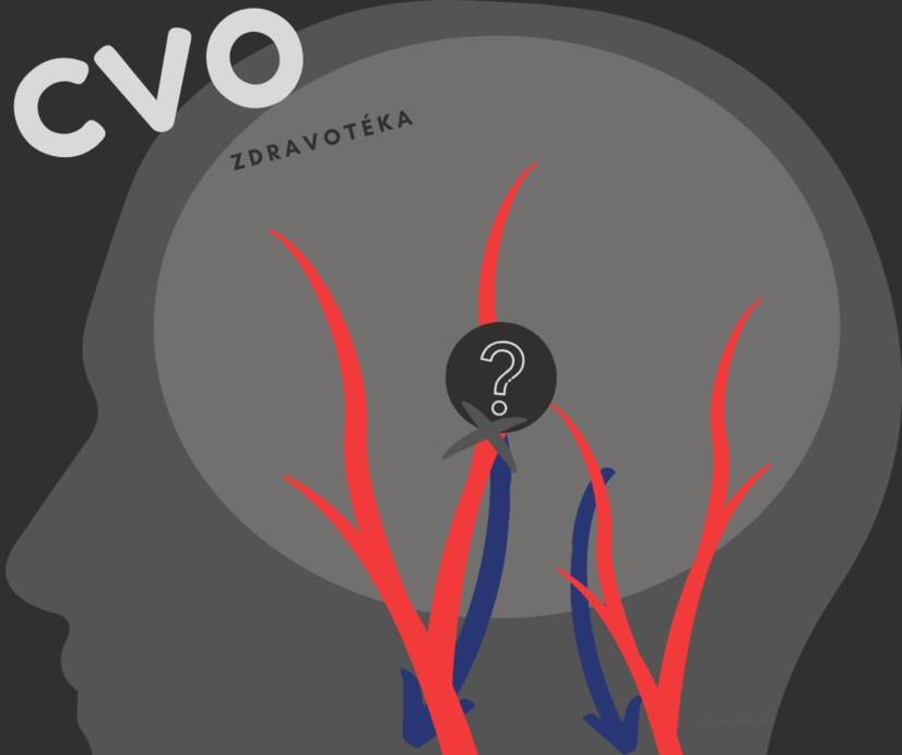 Aivoverisuonisairaus: heikentyneet, ahtautuneet tai laajentuneet aivoverisuonet? Tunne syyt ja oireet.