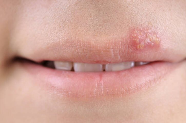 Herpes: miksi herpes esiintyy ja mikä auttaa hoidossa (mitä huuliherpes)?