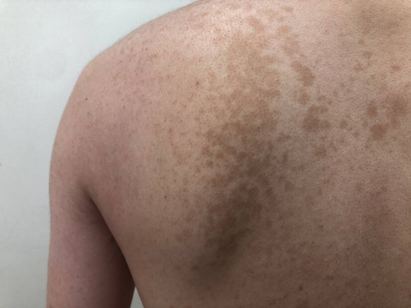 Pityriasis versicolor: Mikä se on ja mitä oireita sillä on? Syyt ja leviäminen