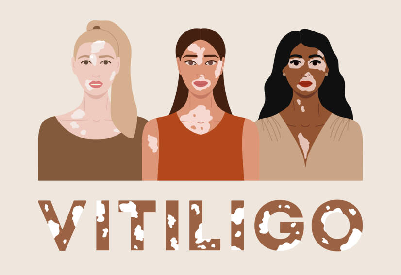 Vitiligo: Mitä vitiligo on, mitkä ovat sen syyt ja oireet ja milloin se alkaa?