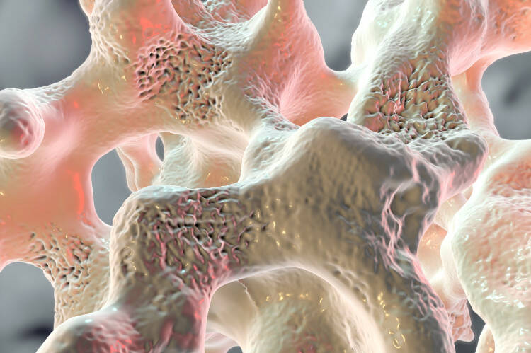 Osteoporoosi, osteogeneesi lapsilla? Miksi se syntyy, miten se ilmenee, miten sitä hoidetaan?